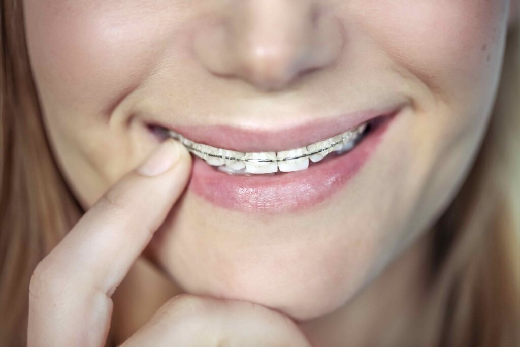 Diş Teli İlgili Çoğumuzun Doğru Sandığı Düşünceler