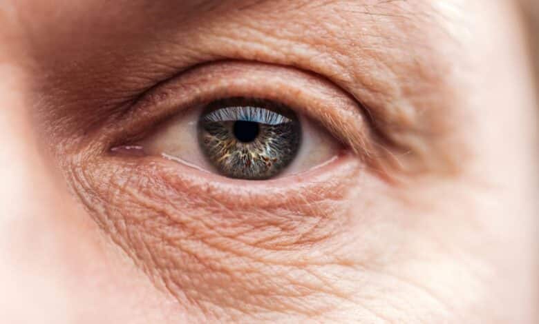 Göz Kapağı Sarkması Nasıl Tedavi Edilir?