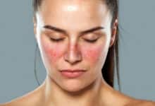 lupus nedir ciltte dokuntulere sebep oluyor NhzYLXBC