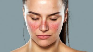 lupus nedir ciltte dokuntulere sebep oluyor NhzYLXBC